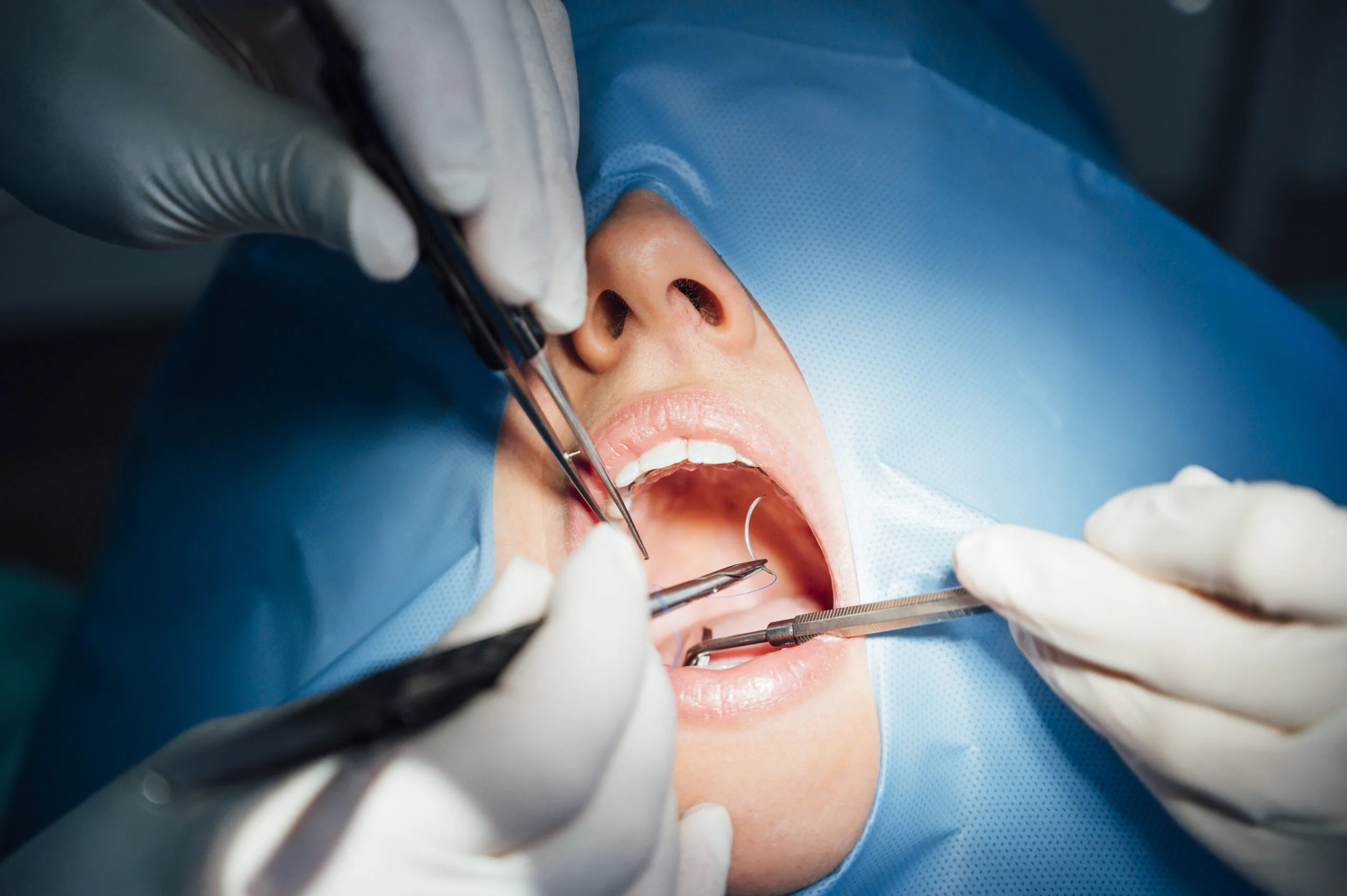 Minor Oral Surgery