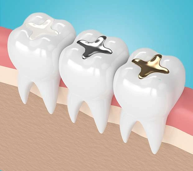 Tooth-Coloured Fillings